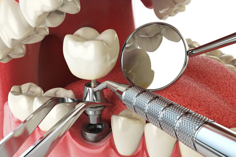 3D Mockup of a dental implant being placed showing the crown, post and implant