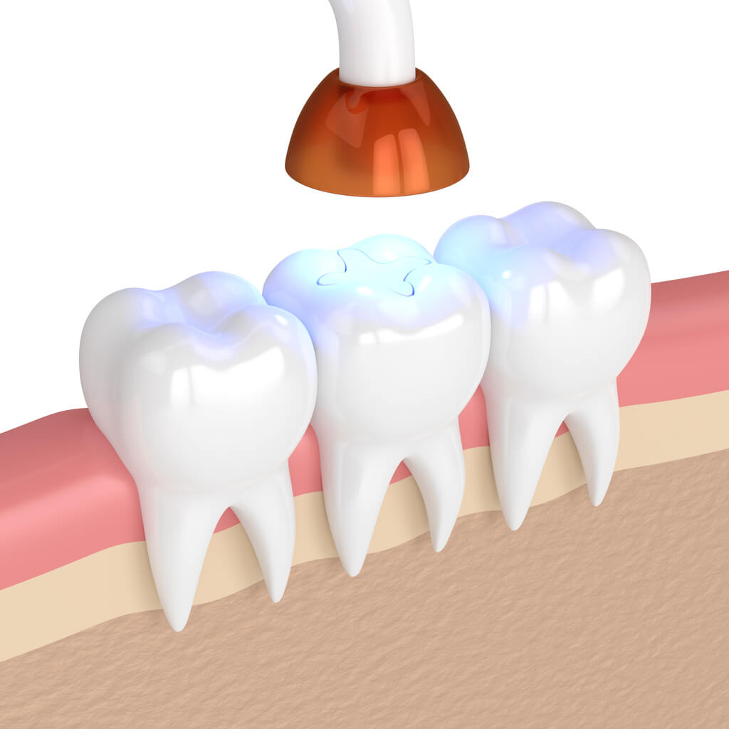 illustration of a tooth-colored filling under a light after being applied to the tooth