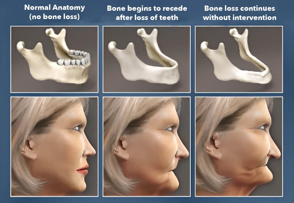 table showing three different stages of bone loss due to missing teeth without replacing them with a dental implant
